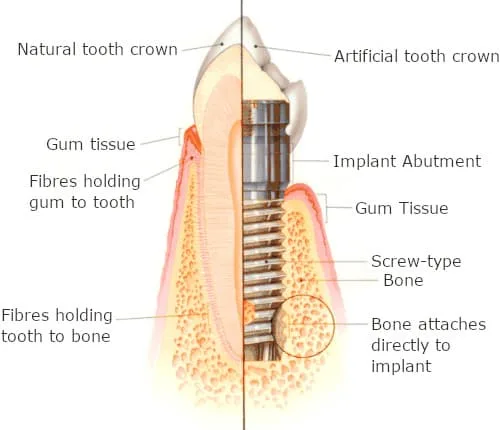 Picture of teh dental Implant components at Castl Hill Dental Care