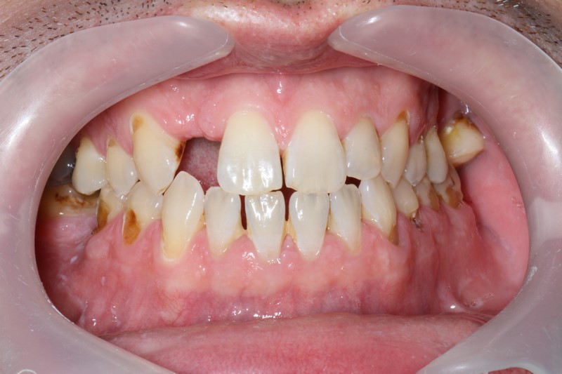 Blake R - Teeth Implant Before