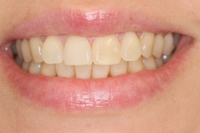 Case 1 Teeth Whitening Before IMG_4205
