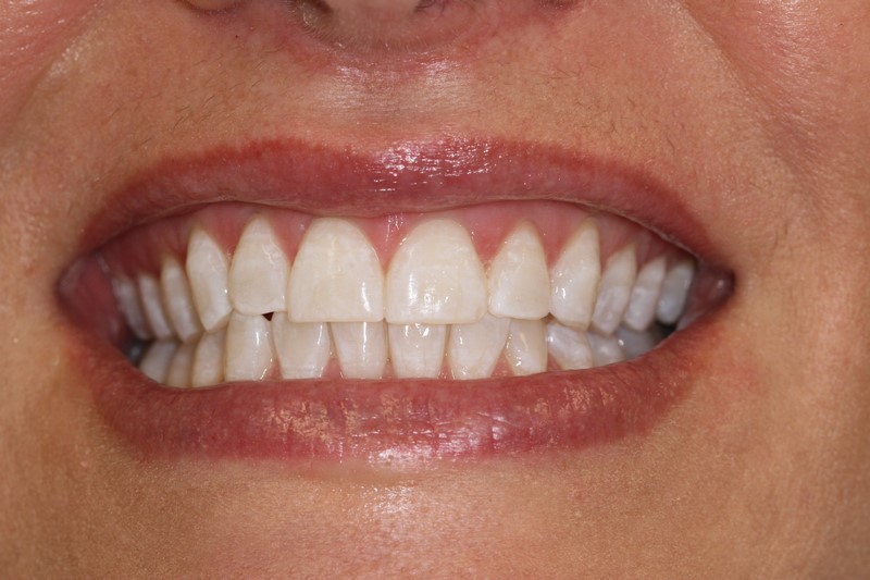 Case 3 Teeth Whitening After