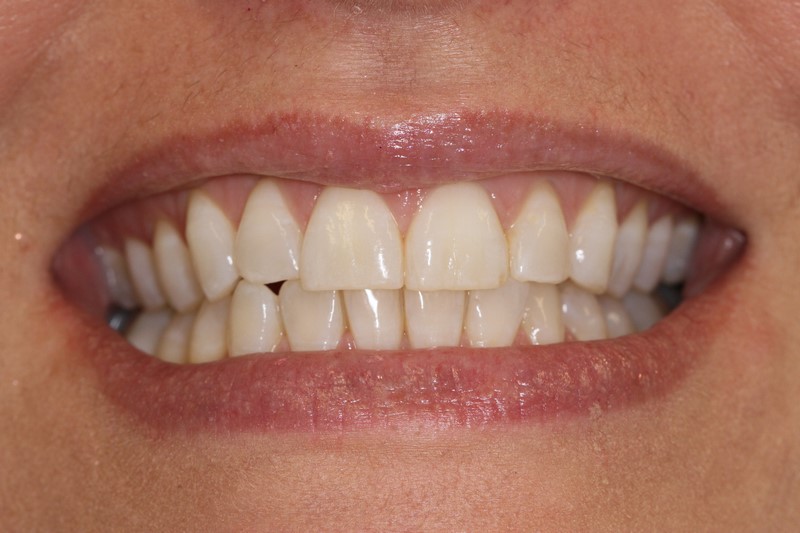 Case 3 Teeth Whitening Before