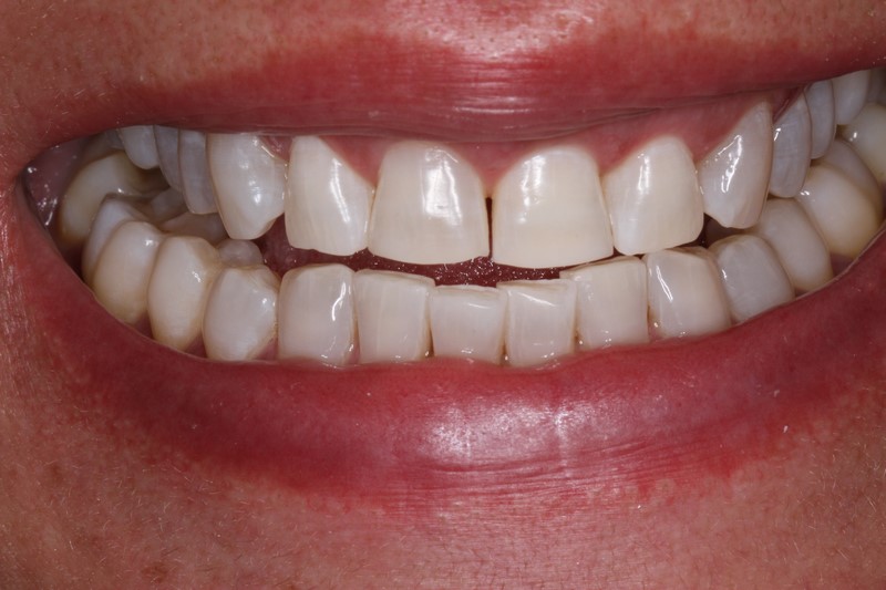 Case 5 Teeth Whitening After