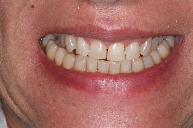 Case 5 Teeth Whitening Before