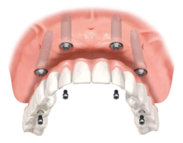 Implant-Supported-Dentures-Overdentures-Castle-Hill-Dental-Care