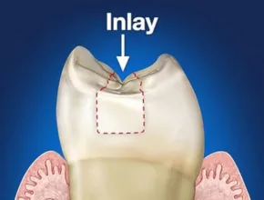 Inlays-Castle-Hill-Dental-Care