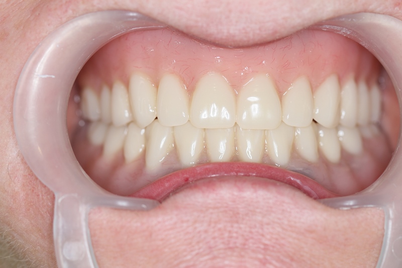Lynne C - Teeth Implant After
