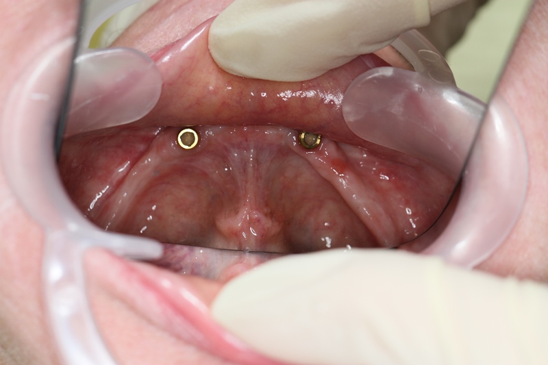 Lynne C - Teeth Implant Before