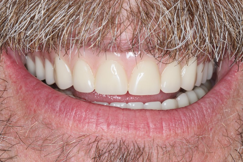 Mark H - Teeth Implant After