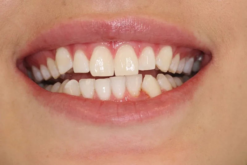 Case 4 Teeth Whitening After