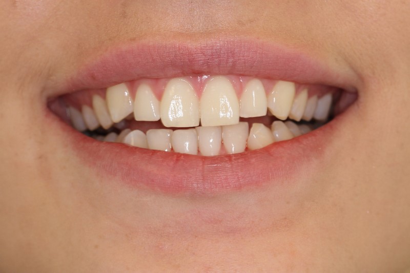Case 4 Teeth Whitening Before