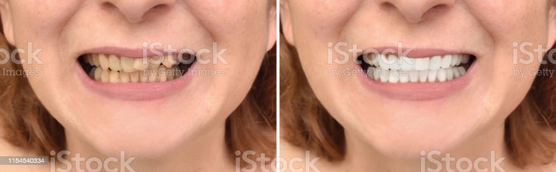 Teeth of a middle-aged woman before and after correction and whitening. Close-up.