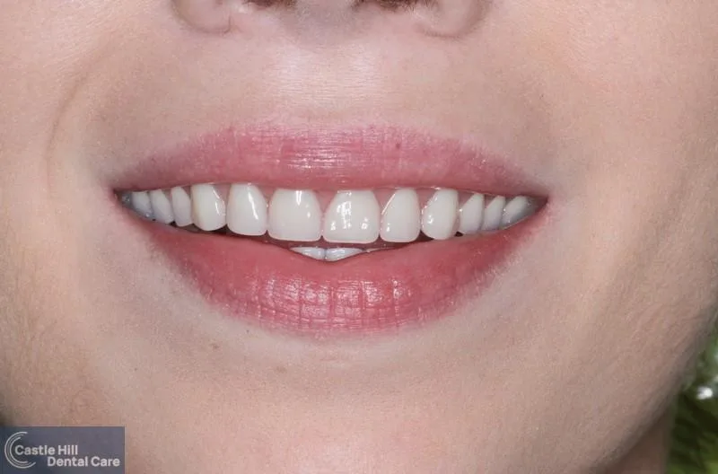 Dentures Photo of young woman with denture smiling
