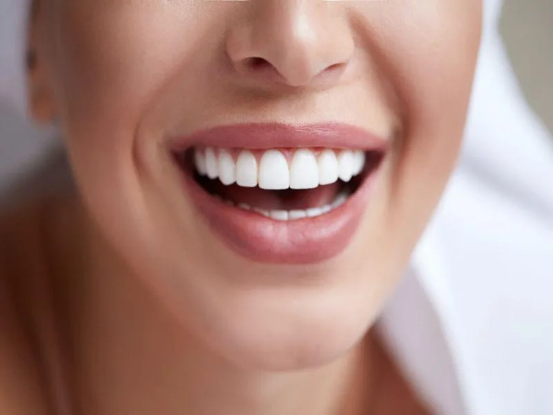 Dental veneers At castle hill dental care