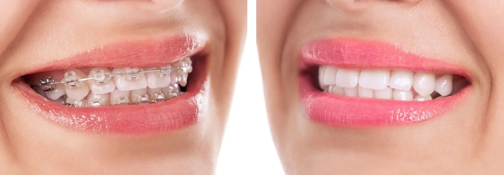 Before and after braces treatment photo