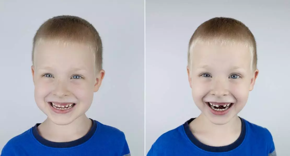 Before and after. Falling out milk tooth. Blond boy in photo has a loose milk tooth