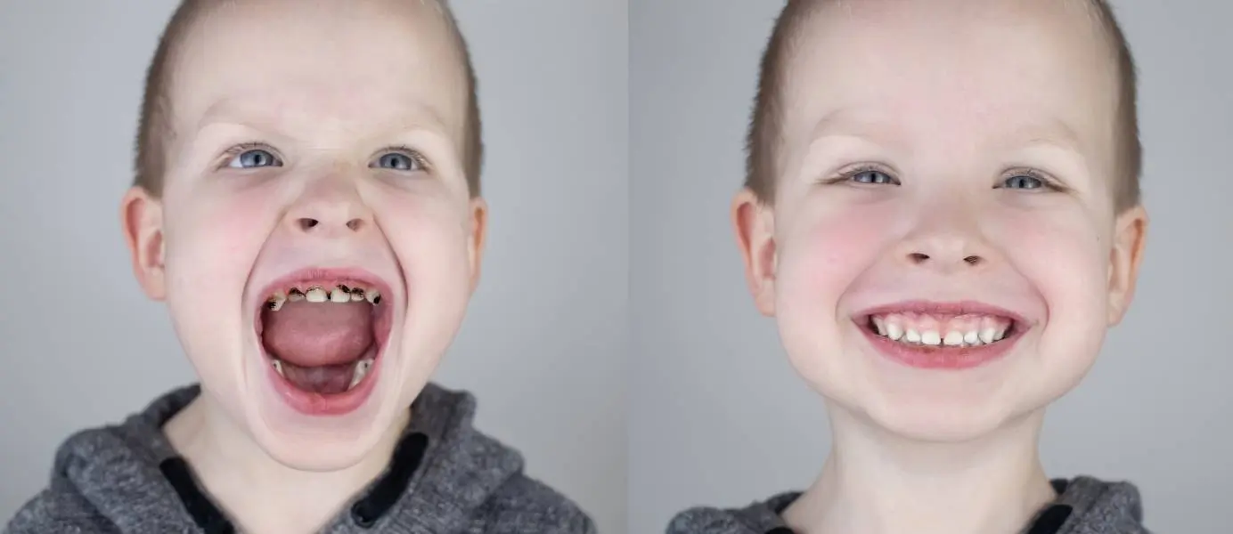 Before and after. The child shows the damaged teeth by caries