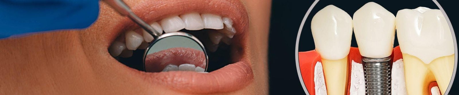 Invisalign promo Image 1920x400px