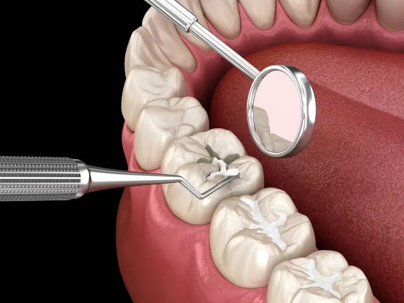 Molar tooth fissure restoration with filling. Medically accurate tooth 3D illustration