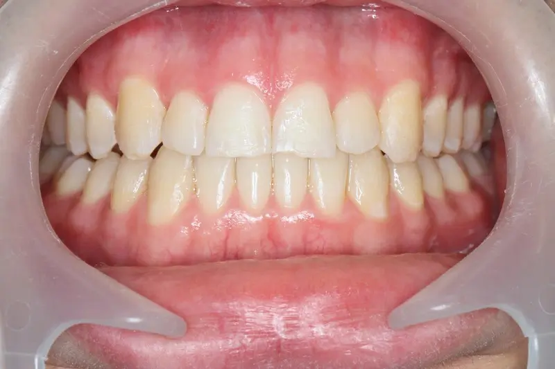 Benefits Of Straight Teeth  Castle Hills 3D Orthodontics