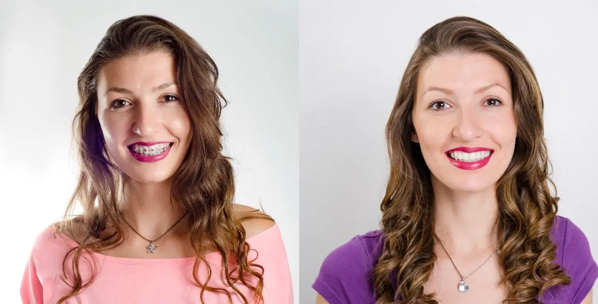 Young woman before and after dental braces, two years apart