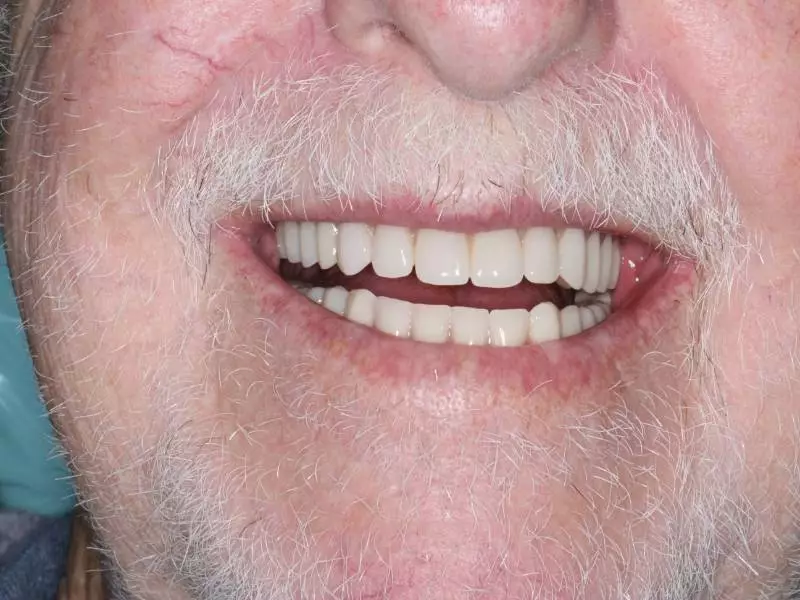Michael W. Full denture after picture in Castle hill dental care