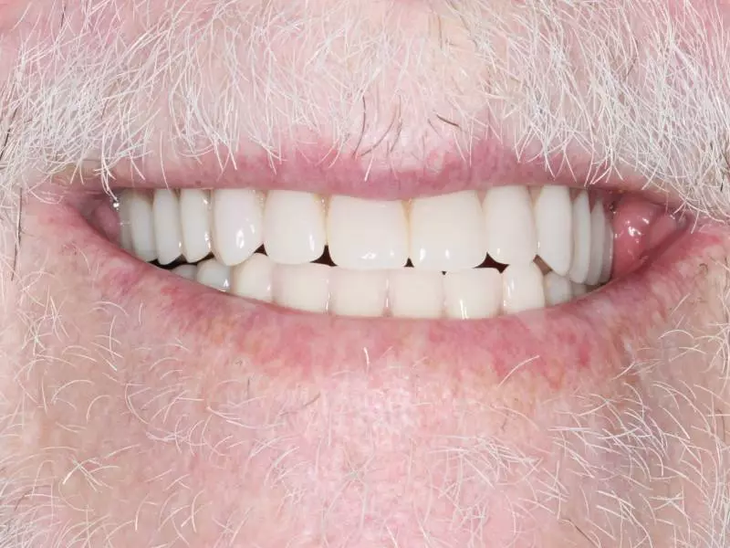 Denture After - IMG_3854