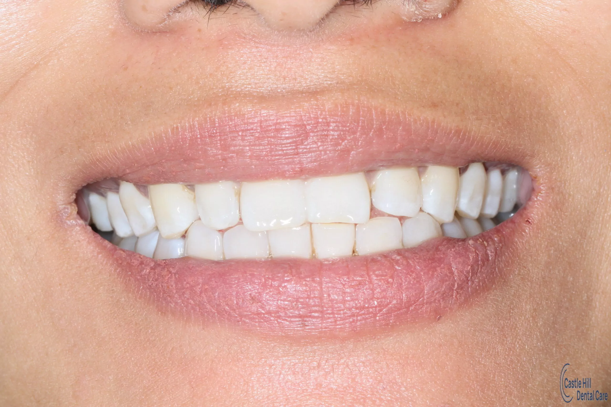 Katerina W. Porcelaing dental veneers before picture at Castle hill dental care