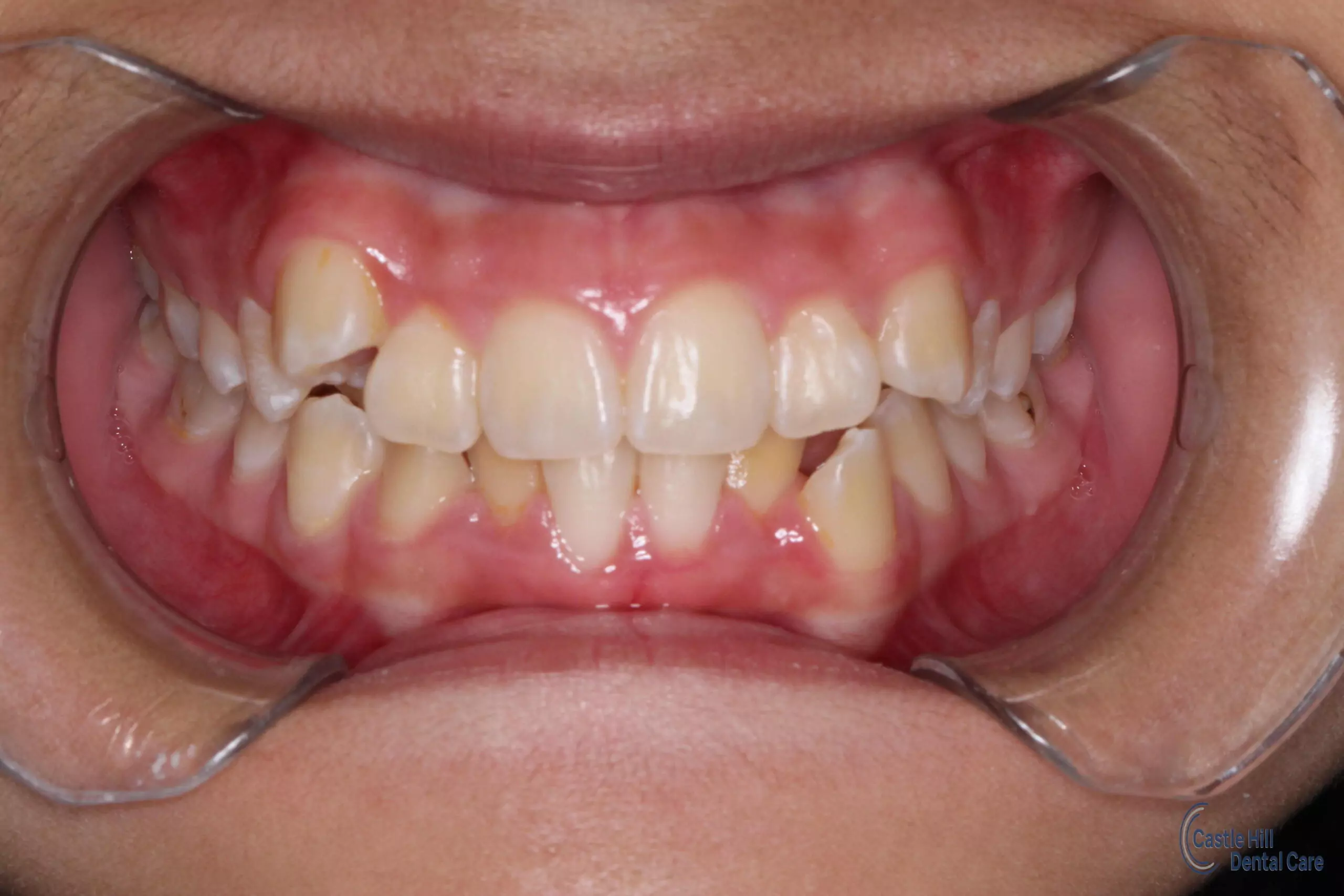 Isabella M. Orthodontic braces before picture