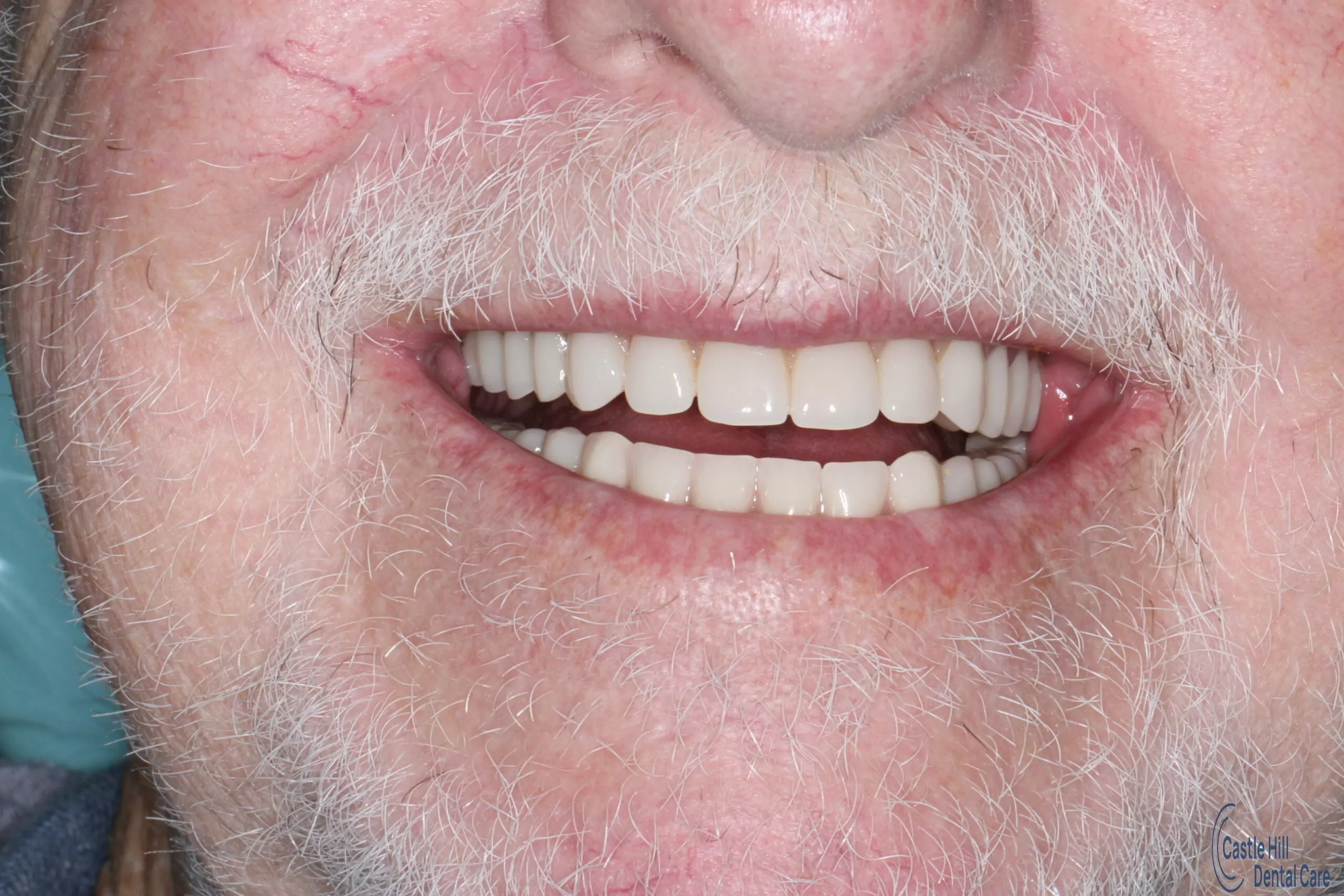 Acrylic dentures after picture.