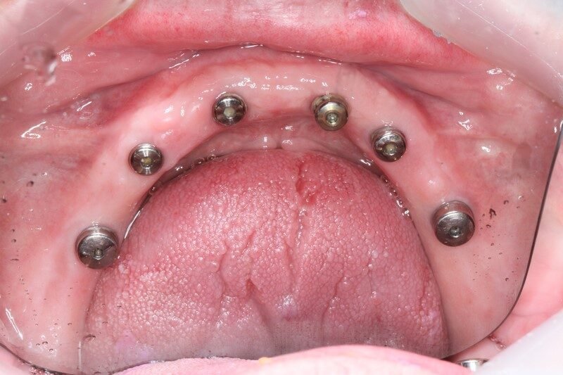 Before and After - Castle Hill | Kellyville | Hills Area Mark-H-Teeth-Implant-Before