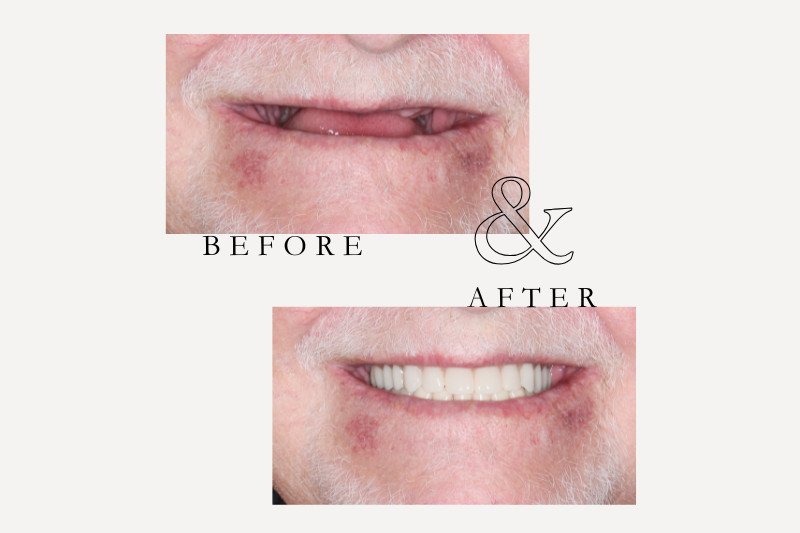 Before & After Smiles | Dentist Castle Hill Before and after full dentures replacing missing teeth Castle Hill