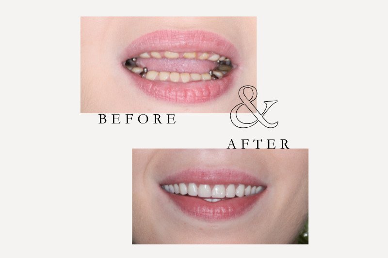 Before & After Smiles | Dentist Castle Hill Dentures before and after replacing worn and missing teeth at Castle Hill Dental Care