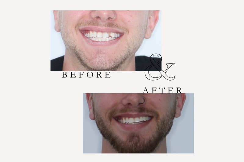 Before & After Smiles | Dentist Castle Hill Before and after orthodontic braces correcting crowded teeth Castle Hill