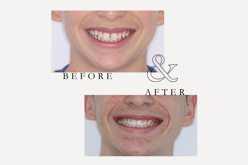 Before & After Smiles | Dentist Castle Hill Before and after orthodontic braces correcting spacing and crowding at Castle Hill Dental Care