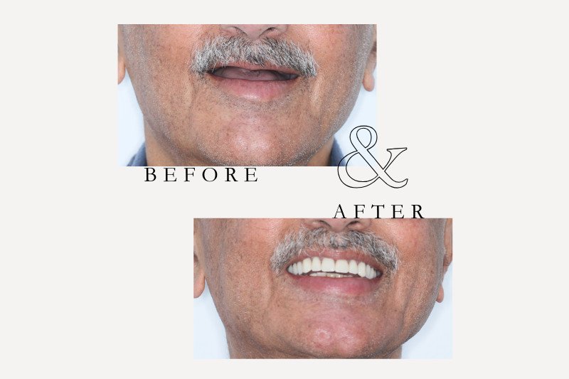 Before & After Smiles | Dentist Castle Hill All-on-4 before and after smile transformation Castle Hill Dental Care patient