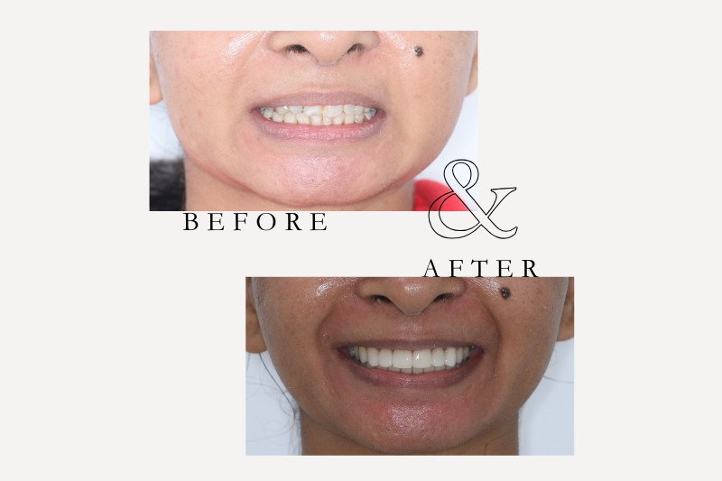 Before & After Smiles | Dentist Castle Hill Porcelain veneers before and after smile makeover Castle Hill patient