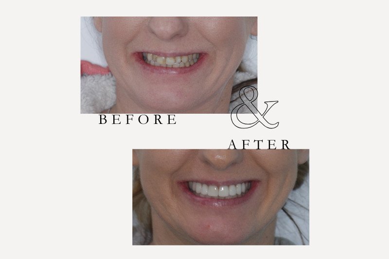 Before & After Smiles | Dentist Castle Hill Porcelain veneers before and after correcting discoloured teeth at Castle Hill Dental Care