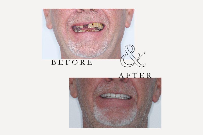 Before & After Smiles | Dentist Castle Hill Before and after All-on-4 replacing dentures with fixed teeth at Castle Hill Dental Care