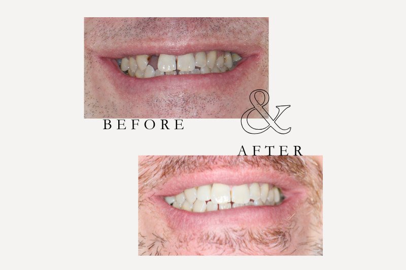 Before & After Smiles | Dentist Castle Hill Before and after single dental implant replacing missing tooth at Castle Hill Dental Care