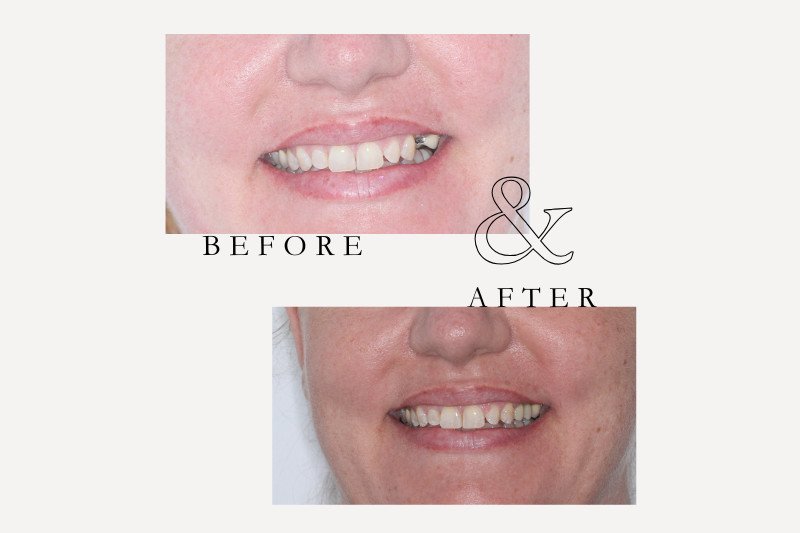 Before & After Smiles | Dentist Castle Hill Dental implant before and after restoring function and smile at Castle Hill Dental Care