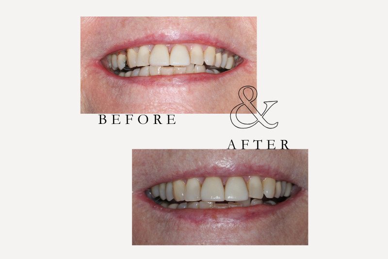 Before & After Smiles | Dentist Castle Hill Before and after single tooth dental implant restoring missing molar at Castle Hill Dental Care