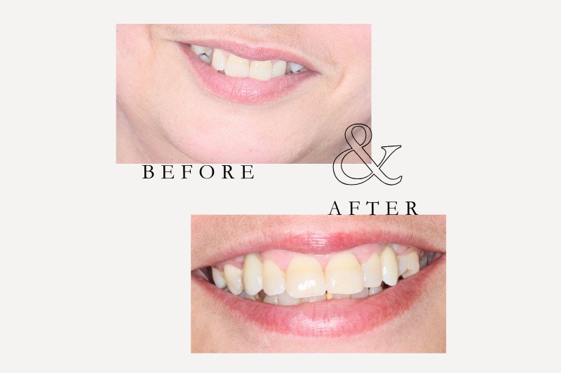 Before & After Smiles | Dentist Castle Hill Dental implants before and after restoring multiple missing teeth at Castle Hill Dental Care