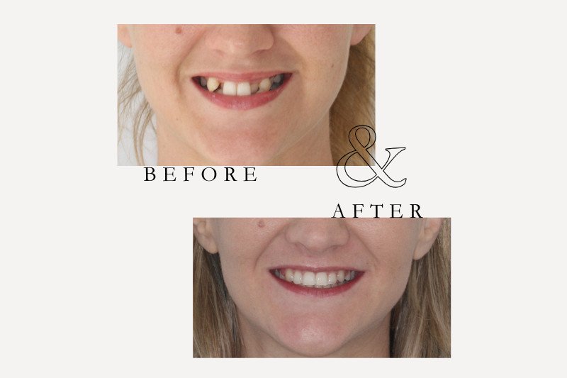 Before & After Smiles | Dentist Castle Hill Invisalign before and after smile makeover Castle Hill Dental Care