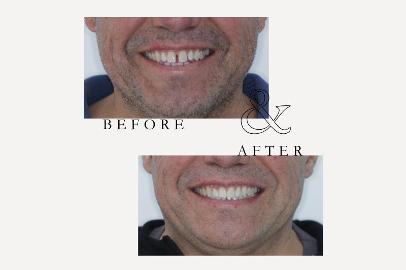 Before & After Smiles | Dentist Castle Hill Invisalign Treatment for Gaps Between Teeth | Castle Hill Dentist
