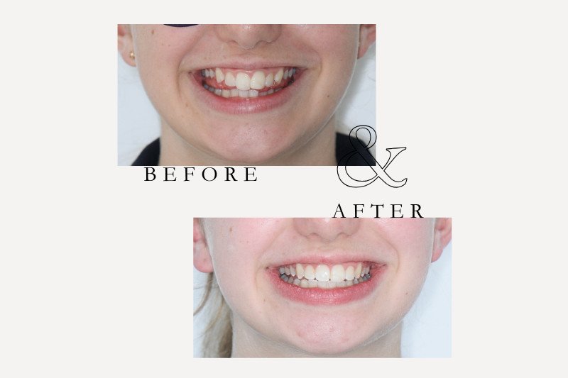 Before & After Smiles | Dentist Castle Hill Invisalign before and after for mild crowding and alignment Castle Hill