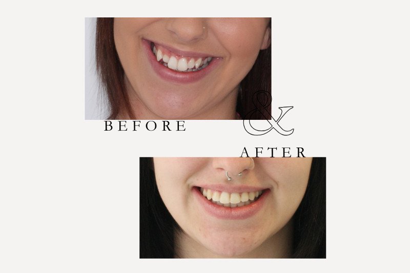 Before & After Smiles | Dentist Castle Hill Before and after Invisalign treatment correcting crowded teeth at Castle Hill Dental Care