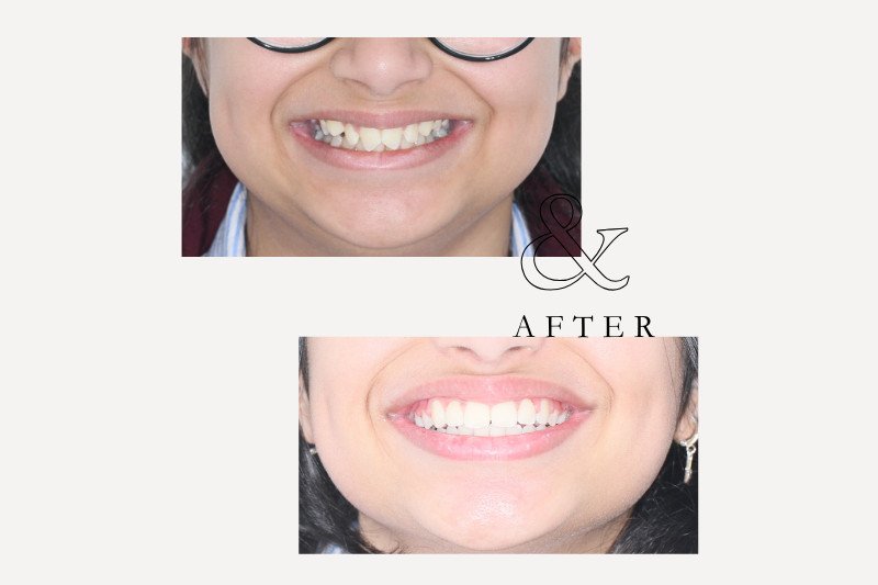 Before & After Smiles | Dentist Castle Hill Before and after Invisalign treatment for overbite correction Castle Hill