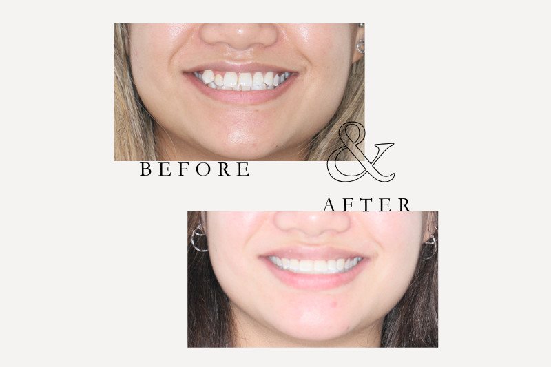 Before & After Smiles | Dentist Castle Hill Before and after Invisalign treatment for crooked front teeth In Castle Hill.