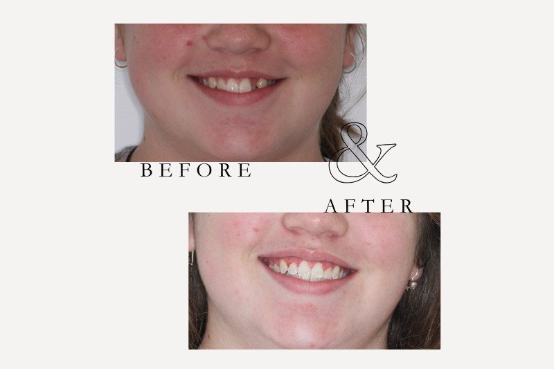 Before and after Invisalign treatment for alignment issues