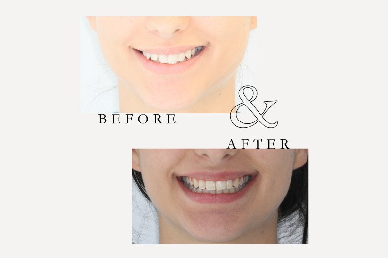 Before & After Smiles | Dentist Castle Hill Invisalign before and after improving smile alignment and bite at Castle Hill Dental Care